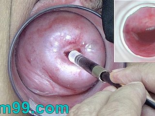 Japanische Endoskop-Kamera innerhalb Cervix Cam in Vagina